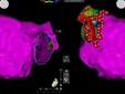 La ricostruzione in 3D di un atrio cardiaco, prima e dopo la procedura di ablazione di fibrillazione atriale.  Nella figura di destra, i pallini indicano le singole mini-bruciature di pochi millimetri attorno alle vene polmonari, con cui viene spenta l'attività elettrica responsabile dell'aritmia, e ripristinato il regolare funzionamento)