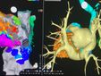 Sul monitor - A destra l’immagine Tac ricostruita dell’atrio di sinistra, a fianco l’immagine ricostruita con i cateteri  con i colori che evidenziano il circuito dell’aritmia