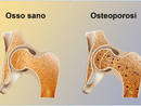 Osteoporosi, prevenirla si può Osteoporosi, prevenirla si può