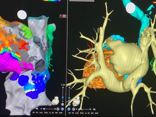 Sul monitor - A destra l’immagine Tac ricostruita dell’atrio di sinistra, a fianco l’immagine ricostruita con i cateteri  con i colori che evidenziano il circuito dell’aritmia
