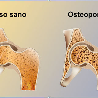 Osteoporosi, prevenirla si può