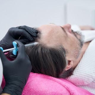 Trattamento della calvizie: 10 metodi chirurgici e non chirurgici e la loro efficacia