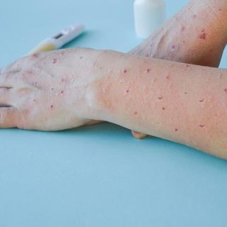 Vaiolo delle scimmie: iniziate anche in Piemonte le vaccinazioni per soggetti a rischio