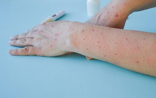Vaiolo delle scimmie: iniziate anche in Piemonte le vaccinazioni per soggetti a rischio Vaiolo delle scimmie: iniziate anche in Piemonte le vaccinazioni per soggetti a rischio