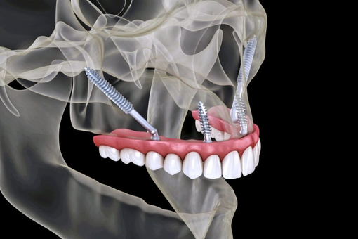 Impianti dentali e poco osso: oggi esistono alternative, ma serve una valutazione seria