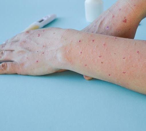Vaiolo delle scimmie: iniziate anche in Piemonte le vaccinazioni per soggetti a rischio