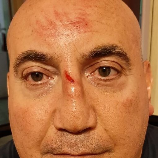Troppe buche sulle strade astigiane costano la caduta dalla carrozzina ad un disabile. &quot;Grazie alla disponibilità dei passanti sono riuscito a tornare a casa&quot;