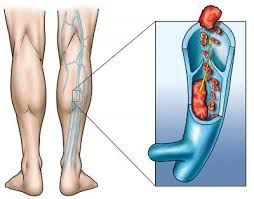 Disturbi vascolari e linfatici: nutraceutica, allenamento e alimentazione Disturbi vascolari e linfatici: nutraceutica, allenamento e alimentazione