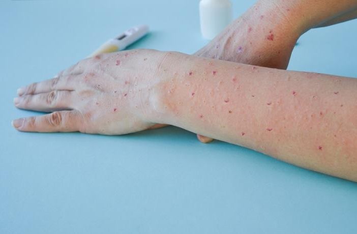 Vaiolo delle scimmie: iniziate anche in Piemonte le vaccinazioni per soggetti a rischio