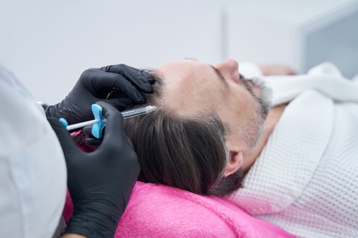 Trattamento della calvizie: 10 metodi chirurgici e non chirurgici e la loro efficacia