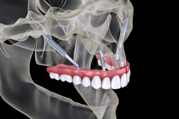 Impianti dentali e poco osso: oggi esistono alternative, ma serve una valutazione seria
