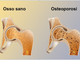 Osteoporosi, prevenirla si può