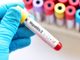 Epatite C: attivo in Piemonte lo screening per la ricerca del virus per la diagnosi precoce