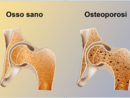 Osteoporosi, prevenirla si può Osteoporosi, prevenirla si può