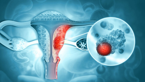 Tumore dell’endometrio, la diagnosi precoce può fare la differenza: specialisti a confronto al Polo Universitario Astiss