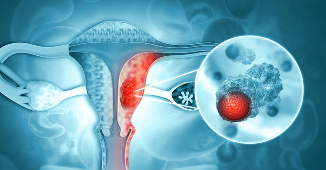 Tumore dell’endometrio, la diagnosi precoce può fare la differenza: specialisti a confronto al Polo Universitario Astiss