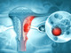 Tumore dell’endometrio, la diagnosi precoce può fare la differenza: specialisti a confronto al Polo Universitario Astiss