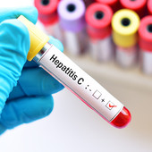 Obiettivo 2030, il Piemonte accelera sulla caccia al virus dell’epatite