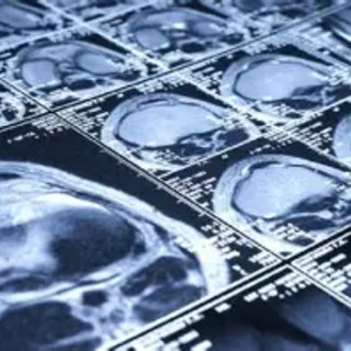Ictus acuto: Azienda Zero lancia il cloud per condividere le immagini radiologiche. Il progetto coinvolge anche Asl At
