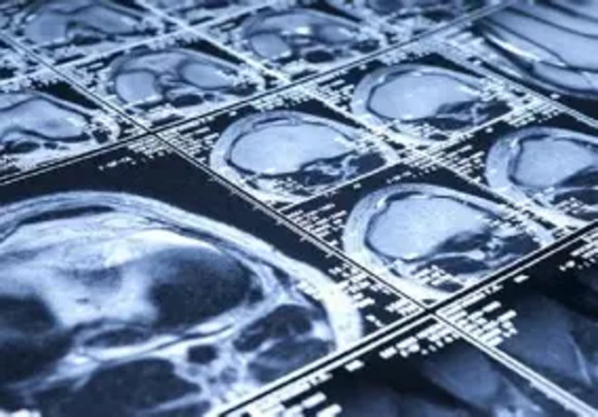 Ictus acuto: Azienda Zero lancia il cloud per condividere le immagini radiologiche. Il progetto coinvolge anche Asl At