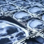 Ictus acuto: Azienda Zero lancia il cloud per condividere le immagini radiologiche. Il progetto coinvolge anche Asl At