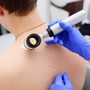 Melanoma day: Piemonte in prima linea per la prevenzione e cura dei tumori della pelle