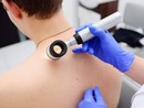 Melanoma day: Piemonte in prima linea per la prevenzione e cura dei tumori della pelle Melanoma day: Piemonte in prima linea per la prevenzione e cura dei tumori della pelle