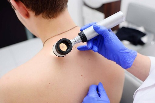 Melanoma day: Piemonte in prima linea per la prevenzione e cura dei tumori della pelle