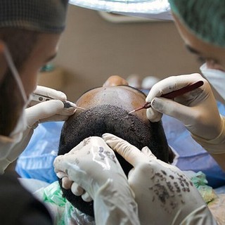 Trapianto capelli Turchia: come pianificare bene e riconoscere una clinica affidabile