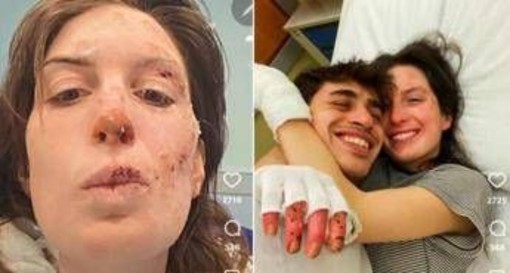 Crans-Montana, oggi dimessi due ragazzi. Eleonora Palmieri mostra le ustioni sui social Crans-Montana, oggi dimessi due ragazzi. Eleonora Palmieri mostra le ustioni sui social