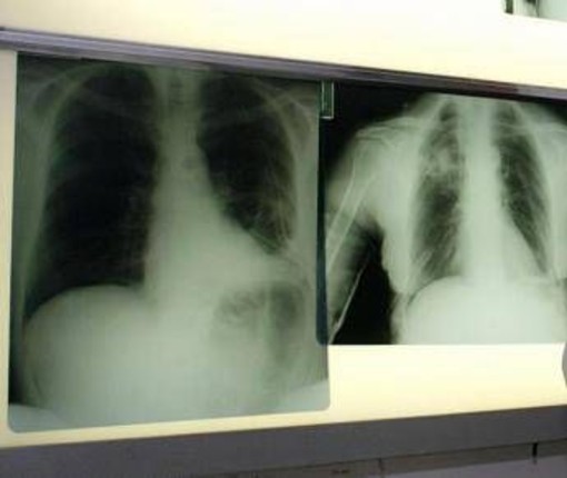 Salute, esperti: &quot;Virus sinciziale sottovalutato nonostante oltre 50mila ricoveri l'anno&quot;