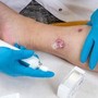 Idrosadenite suppurativa, quando fare la doccia o dormire diventano ostacoli