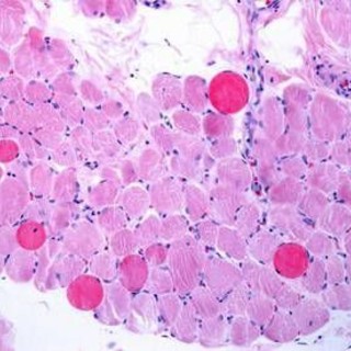 Malattie rare, risultati positivi a 5 anni per vamorolone in distrofia Duchenne