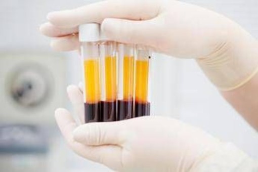 Plasmaderivati, Lecci (Sda Bocconi): &quot;Serve un’innovazione rapida meno costosa&quot;