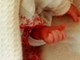 Torino, neonata salvata da rara malformazione al fegato con colla istantanea