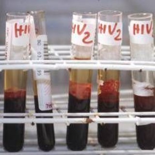 Hiv, il 90% dei pazienti sceglie terapia long acting