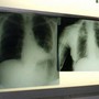 Salute, esperti: &quot;Virus sinciziale sottovalutato nonostante oltre 50mila ricoveri l'anno&quot;