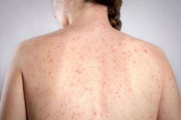 Morbillo, l'allarme dell'infettivologo Andreoni: "Casi in crescita, ricoveri frequenti negli adulti"