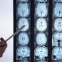 Di Battista e il tumore al cervello, in Italia circa 6mila diagnosi ogni anno: quali sono i sintomi 'spia'