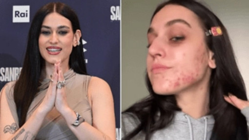 Gaia senza filtri, mostra l'acne sul viso: &quot;Ho pensato di nascondermi, voglio normalizzare&quot;