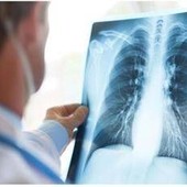 Cancro polmone Egfr-mutato, studio fase 3 Adaura: "Il 79% dei pazienti vivo a 8 anni con Osimertinib" Cancro polmone Egfr-mutato, studio fase 3 Adaura: "Il 79% dei pazienti vivo a 8 anni con Osimertinib"