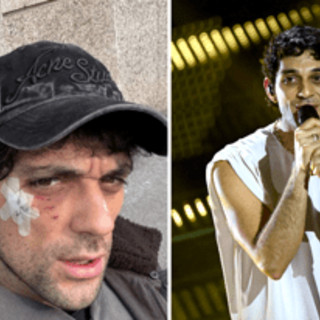 Bresh ferito al volto da un Dobermann, come sta il cantante Bresh ferito al volto da un Dobermann, come sta il cantante