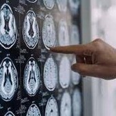 Stop tremori Parkinson senza bisturi, 10 pazienti curati con ultrasuoni a Napoli