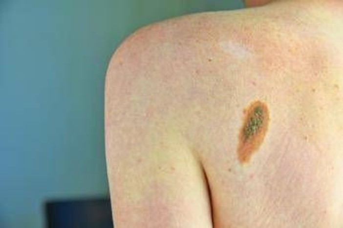 Melanoma, la firma mutazionale del cancro potrà cambiare la cura Melanoma, la firma mutazionale del cancro potrà cambiare la cura