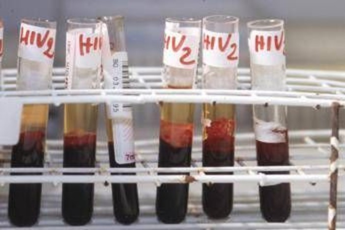 Aids, l'accusa di Bassetti: &quot;Torna a far paura per colpa di Trump&quot;