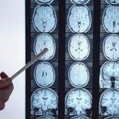 Di Battista e il tumore al cervello, in Italia circa 6mila diagnosi ogni anno: quali sono i sintomi 'spia' Di Battista e il tumore al cervello, in Italia circa 6mila diagnosi ogni anno: quali sono i sintomi 'spia'
