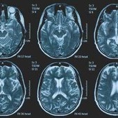 Tumori, glioma pediatrico di basso grado: via libera in Europa a prima terapia mirata
