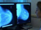 Donne operate per tumore al seno, 70% paga cure e 30% teme per il lavoro