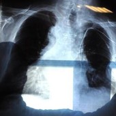 Bpco, pneumologa Foschino Barbaro: "Nella donna sintomi diversi, attenzione alle giovani" Bpco, pneumologa Foschino Barbaro: "Nella donna sintomi diversi, attenzione alle giovani"