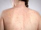 Morbillo, l'allarme dell'infettivologo Andreoni: "Casi in crescita, ricoveri frequenti negli adulti"